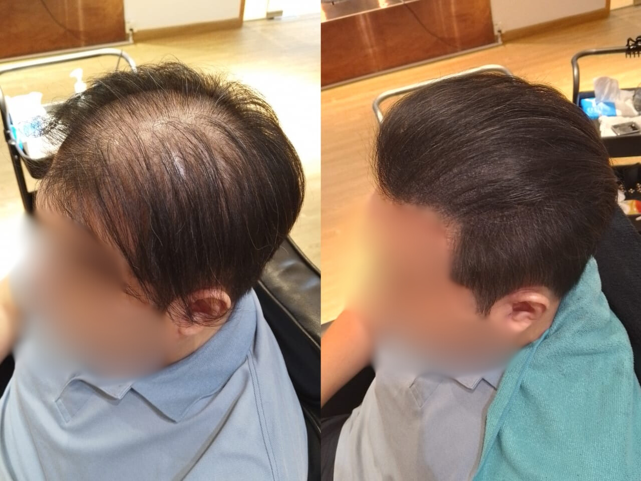 Malaysia Hair Regrowth Before & After Comparison 