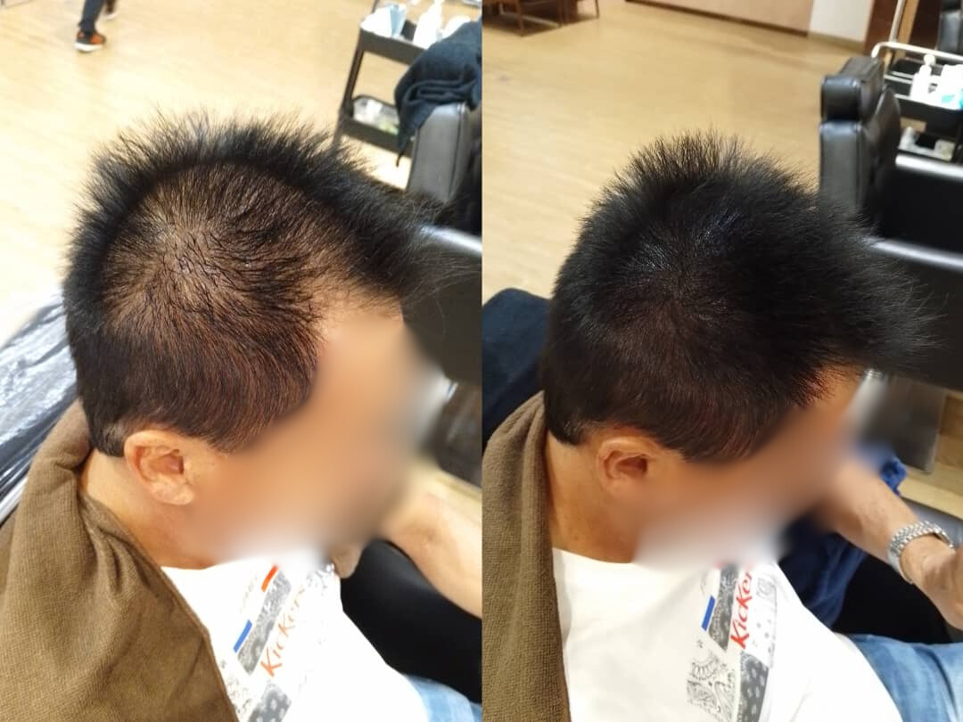 Malaysia Hair Regrowth Before & After Comparison 
