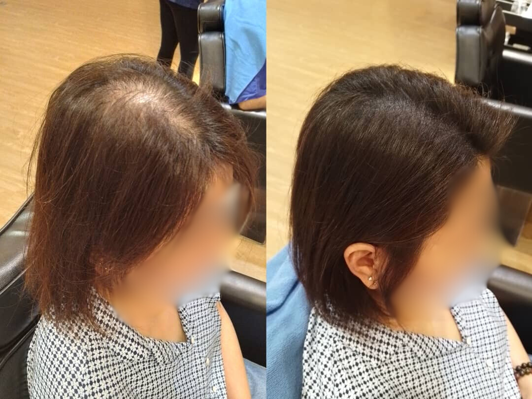 Malaysia Hair Regrowth Before & After Comparison 