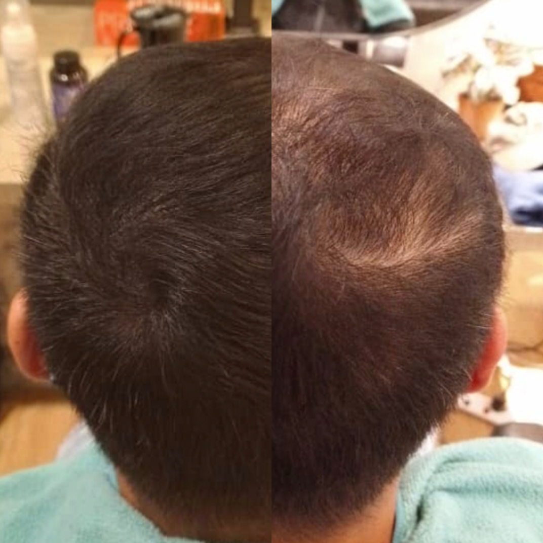 Malaysia Hair Regrowth Before & After Comparison 