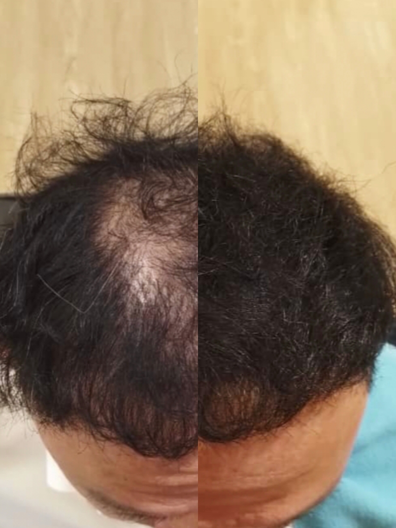 Malaysia Hair Regrowth Before & After Comparison 