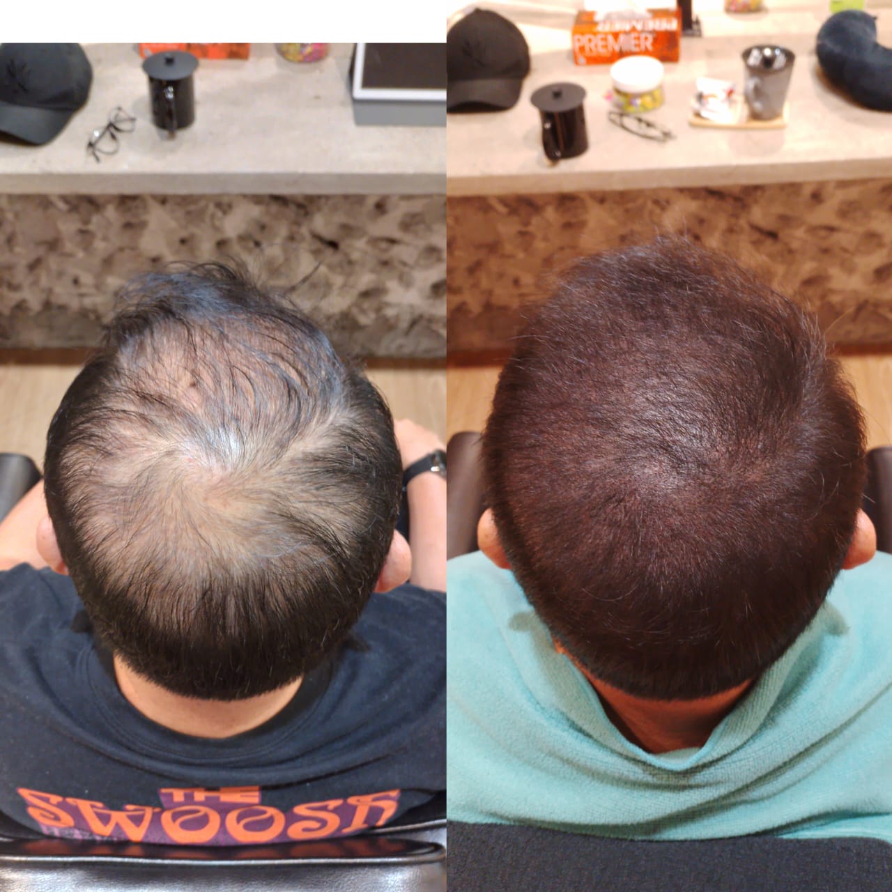 Malaysia Hair Regrowth Before & After Comparison 