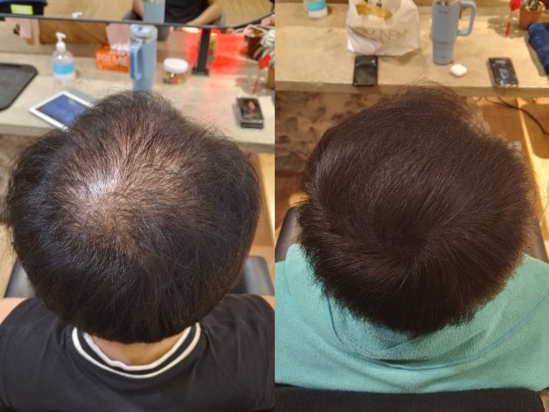 Malaysia Hair Regrowth Before & After Comparison 