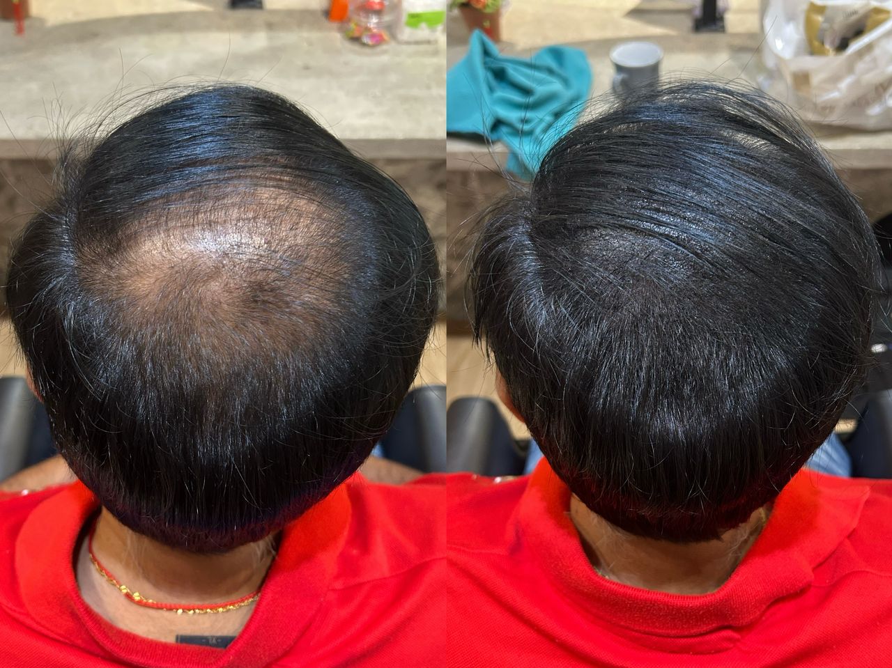 Malaysia Hair Regrowth Before & After Comparison 