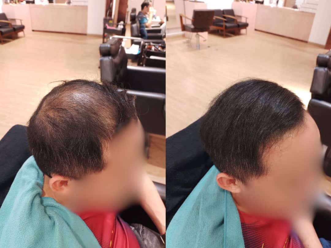 Malaysia Hair Regrowth Before & After Comparison 