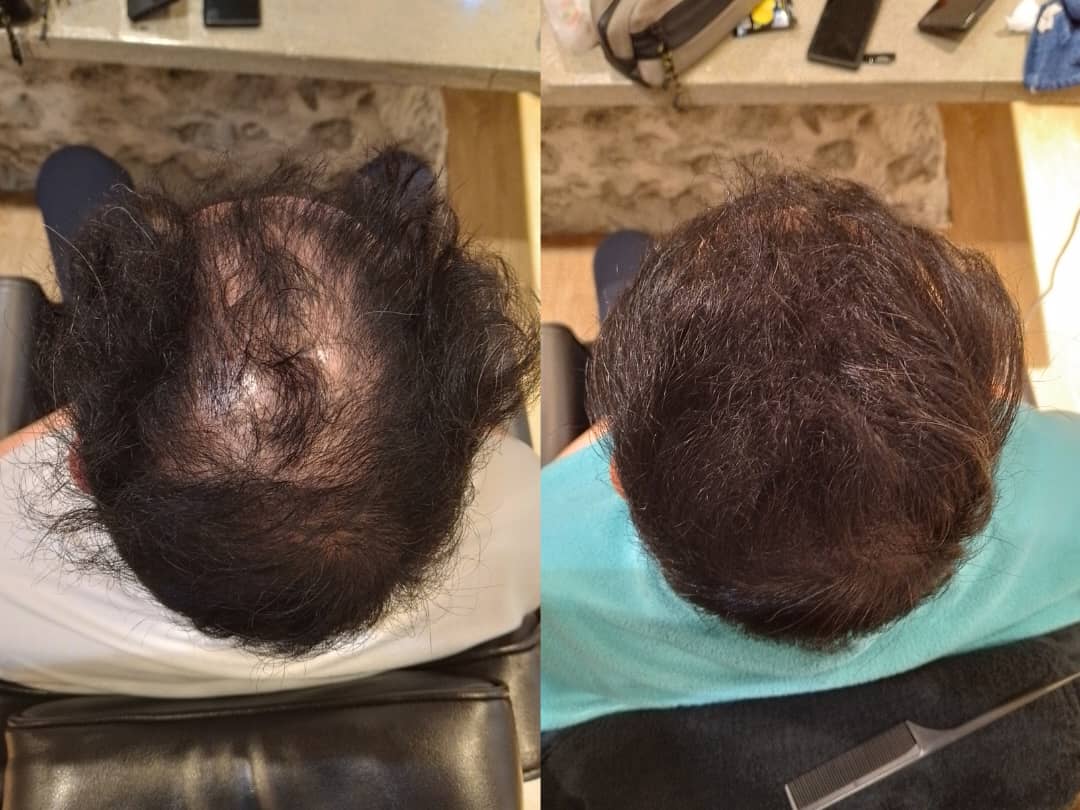 Malaysia Hair Regrowth Before & After Comparison 