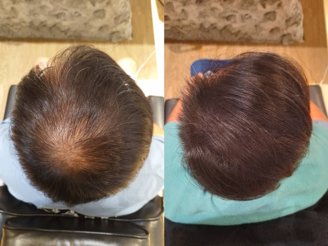 Malaysia Hair Regrowth Before & After Comparison 